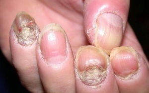 Biện pháp tự nhiên giúp giảm vảy nến móng tay