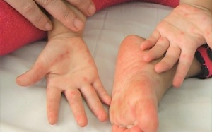 Phòng ngừa và cải thiện bệnh tay chân miệng hiệu quả bằng thảo dược