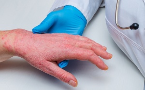 Sử dụng thảo dược giúp cải thiện bệnh viêm khớp vảy nến 