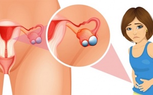 Cải thiện u nang buồng trứng bằng sản phẩm thảo dược 
