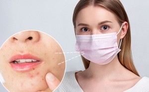 Ngăn ngừa mụn khi đeo khẩu trang thường xuyên
