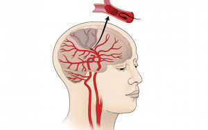 Tại sao nên dùng nattokinase để phòng ngừa và cải thiện đột quỵ não do cục máu đông?