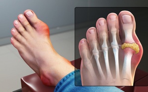 Giảm cơn đau gout an toàn, hiệu quả nhờ sản phẩm thảo dược