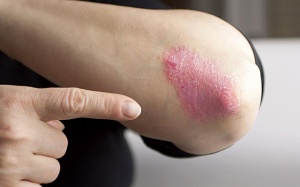 Cách cải thiện bệnh vảy nến thể mảng an toàn, hiệu quả