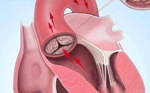Bệnh hẹp van tim có nguy hiểm không, làm sao kiểm soát?