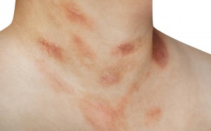 Làm thế nào để cải thiện tình trạng vảy phấn hồng trên da?