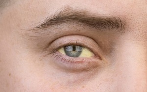 Triệu chứng, biến chứng và cách điều trị vàng da tắc mật do sỏi mật