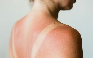 Những sai lầm cần tránh khi bị cháy nắng ngày Hè