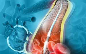 Tắc hẹp mạch vành: Khi nào cần đặt stent mạch vành?