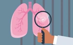 Những đối tượng nguy cơ cao, cần sớm tầm soát ung thư phổi 