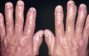 Giải pháp cải thiện vảy nến thể khớp an toàn, hiệu quả