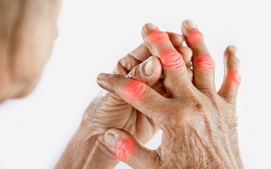 Thảo dược – xu hướng mới giúp cải thiện bệnh gout