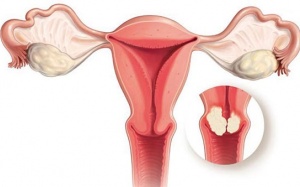 Xu hướng cải thiện u xơ tử cung bằng sản phẩm thảo dược 