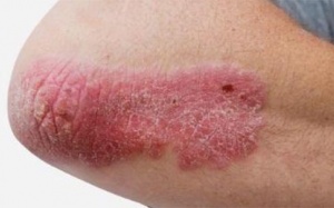 Giải pháp thảo dược cải thiện bệnh vảy nến thể mảng an toàn, hiệu quả