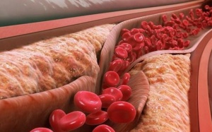 Những dấu hiệu nhận biết xơ vữa động mạch 