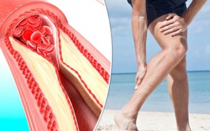 Coi chừng đái tháo đường dẫn tới xơ vữa động mạch