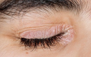 Cách ngăn ngừa biến chứng ở vảy nến vùng mắt