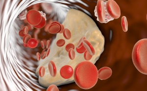 Những loại thuốc thường được chỉ định điều trị xơ vữa động mạch