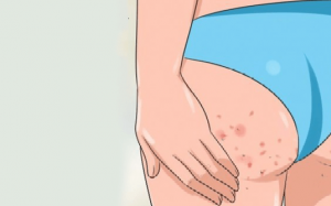 Bị mọc mụn ở mông, làm gì nhanh khỏi?
