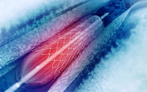 Cần lưu ý gì để hồi phục sức khỏe sau phẫu thuật nong mạch, đặt stent?