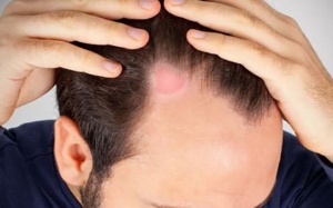 Cách trị nấm da đầu tại nhà hiệu quả