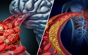 Biến chứng xơ vữa động mạch trên não và tim