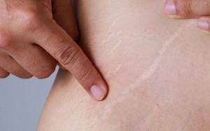 Mẹo khắc phục tình trạng rạn da bằng các nguyên liệu tự nhiên 