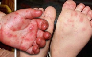 Cảnh giác với bệnh tay chân miệng gây biến chứng nguy hiểm cho trẻ