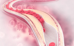 Phòng ngừa xơ vữa động mạch như thế nào?