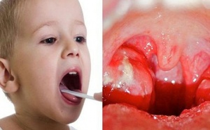 Viêm amidan hốc mủ ở trẻ em và giải pháp cải thiện