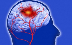 Tại sao người bị xơ vữa động mạch có nguy cơ đột quỵ, tai biến mạch máu não?