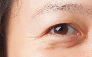 Mẹo “đánh bay” bọng mắt ngay tại nhà