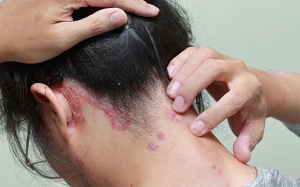 Bí quyết chăm sóc tóc dành cho người bệnh vảy nến da đầu