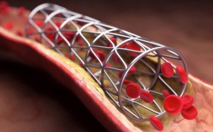 Người đặt stent mạch vành sống được bao lâu, làm thế nào kéo dài tuổi thọ?
