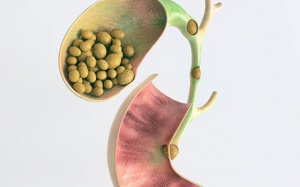 Tán sỏi ống mật chủ: Những điều cần biết trước khi thực hiện