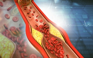 Mối liên hệ giữa xơ vữa động mạch và mỡ máu cao