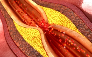 Mỡ máu cao nguy cơ gây xơ vữa động mạch