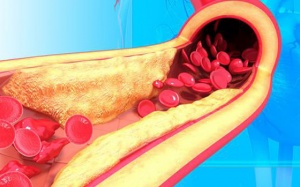 Mỡ máu cao không có triệu chứng làm tăng nguy cơ xơ vữa động mạch, đột quỵ