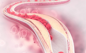 Cách phòng xơ vữa động mạch ở người mỡ máu cao