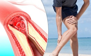 Xơ vữa động mạch kèm mỡ máu cao làm tăng nguy cơ tàn phế?