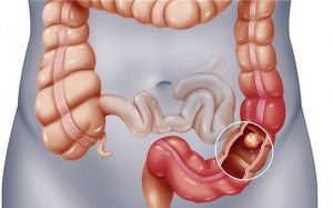 Dấu hiệu nhận biết sớm bệnh ung thư trực tràng