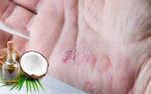 Loại tinh dầu nào giúp cải thiện tình trạng vảy nến?