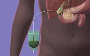 Quy trình chăm sóc dẫn lưu Kehr sau mổ sỏi mật như thế nào?