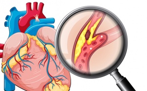 Các biện pháp để xác định bệnh xơ vữa động mạch vành hiện nay