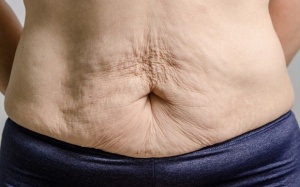 Làm sao để khắc phục tình trạng da chùng nhão, chảy xệ sau giảm cân?