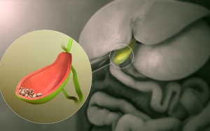 Những triệu chứng sỏi túi mật bạn không nên bỏ qua