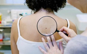 Cách trị bệnh dày sừng tiết bã thế nào?