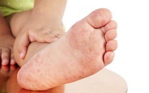 Dấu hiệu nhận biết sớm bệnh tay chân miệng độ 1 cha mẹ cần lưu ý