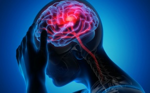 5 biến chứng thường gặp của nhồi máu não