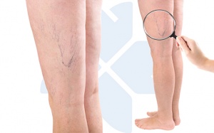 Làm thế nào để thoát khỏi chứng suy giãn tĩnh mạch một cách tự nhiên?